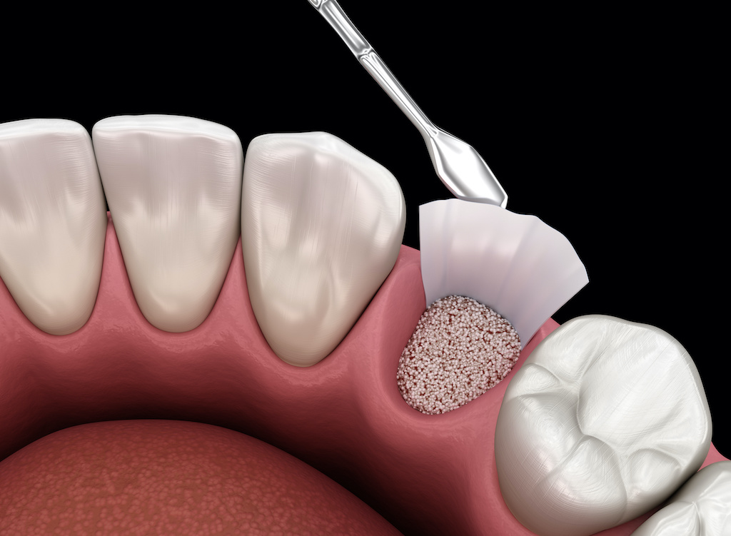 Bone grafts may be required for a successful dental implant.