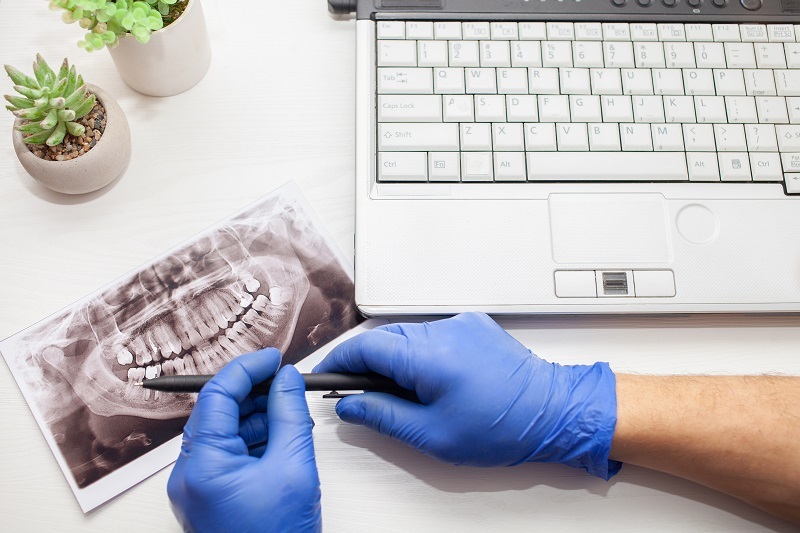Dental surgeon examines x-ray to determine whether wisdom teeth removal is necessary.