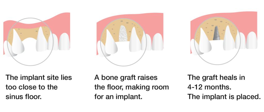 This shows how a bone graft helps a dental implant stay in the mouth and help the patient